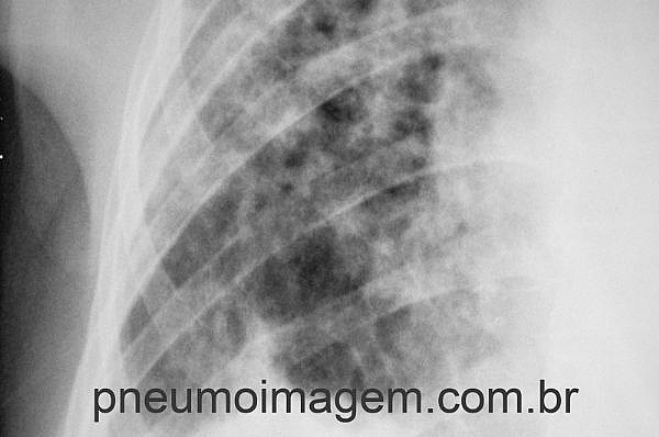 DESTAQUES DO CHEST 2015: FIBROSE PULMONAR IDIOPÁTICA ASSOCIADA A OUTRAS DOENÇAS DESTAQUES DO CHEST 2015: FIBROSE PULMONAR IDIOPÁTICA ASSOCIADA A OUTRAS DOENÇAS